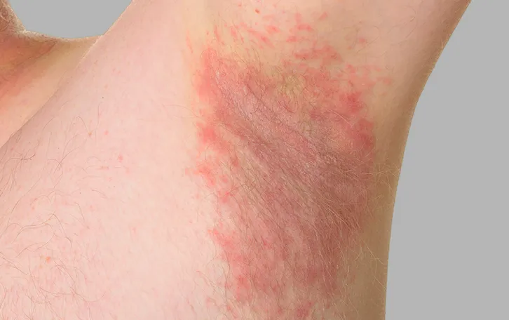 Geröteter Achselbereich