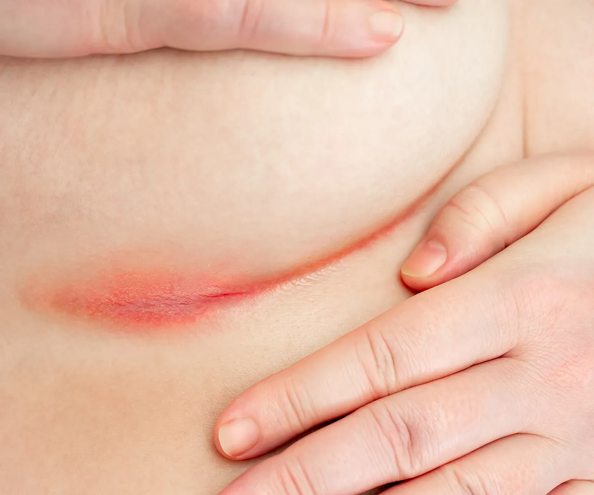 Rötliche bis offene Hautstellen unter dem Brustbereich einer Frau