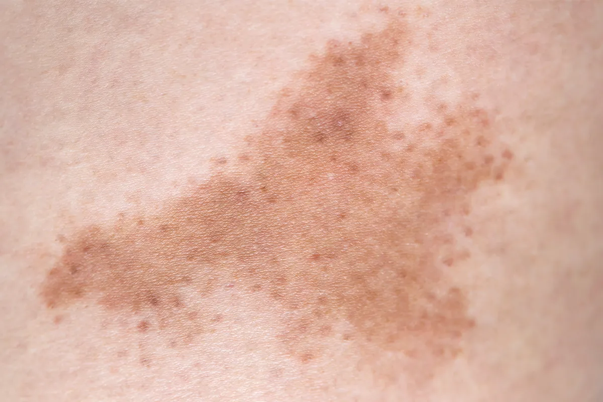 Dunkle Hautflecken