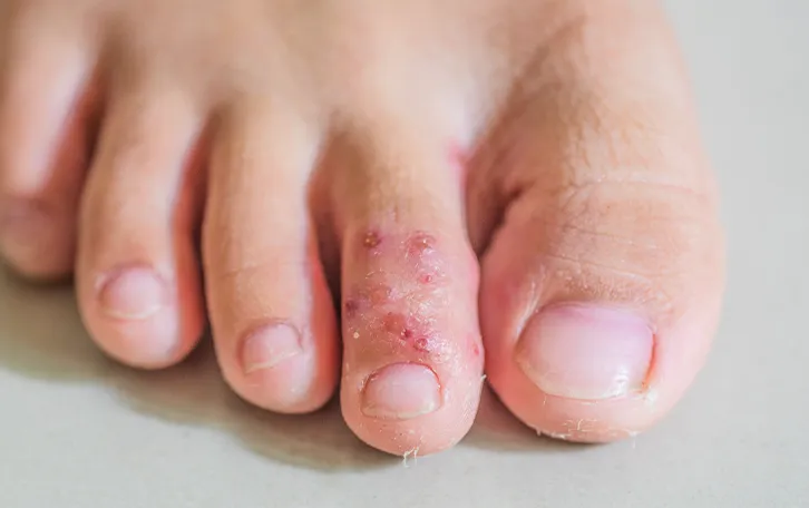 Nahaufnahme von Bläschenbildung am Zehrücken am rechten Fuss