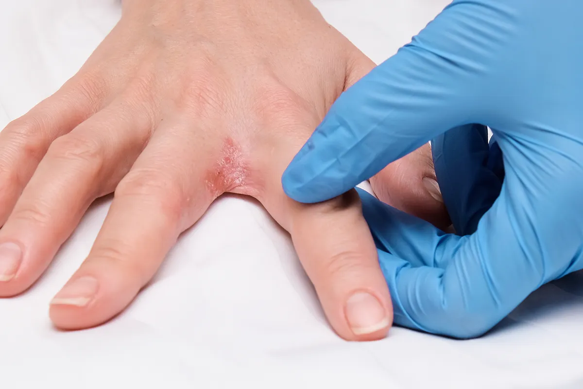 Eine Hand in Latexhandschuhen spreitzt die Finger einer Hand. Dazwischen ist eine offene rissige rötliche Stelle