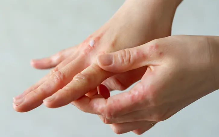 Hand mit vielen rötlichen Stellen an den Fingern und Handrücken