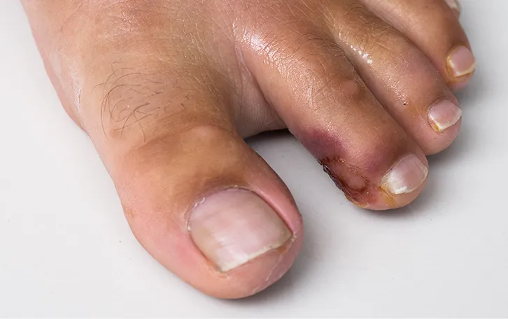 Nahaufnahme eines Fußes mit näßenden Wunden im Zehenbereich