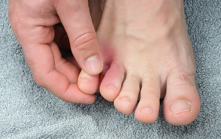 Rote Stellen auf der Haut am rechten kleinen Zeh