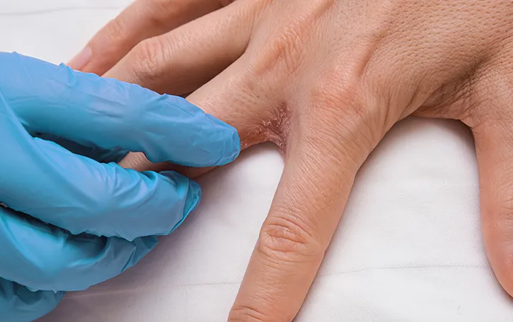 Eine Hand in Latexhandschuhen spreitzt die Finger einer Hand. Dazwischen ist eine offene rissige rötliche Stelle