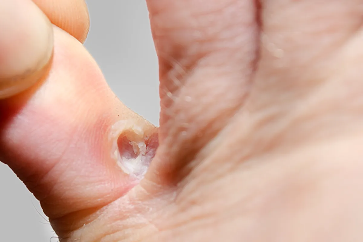 Pilzinfektion zwischen den Zehen