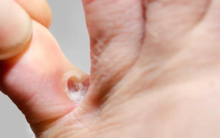 Pilzinfektion zwischen den Zehen