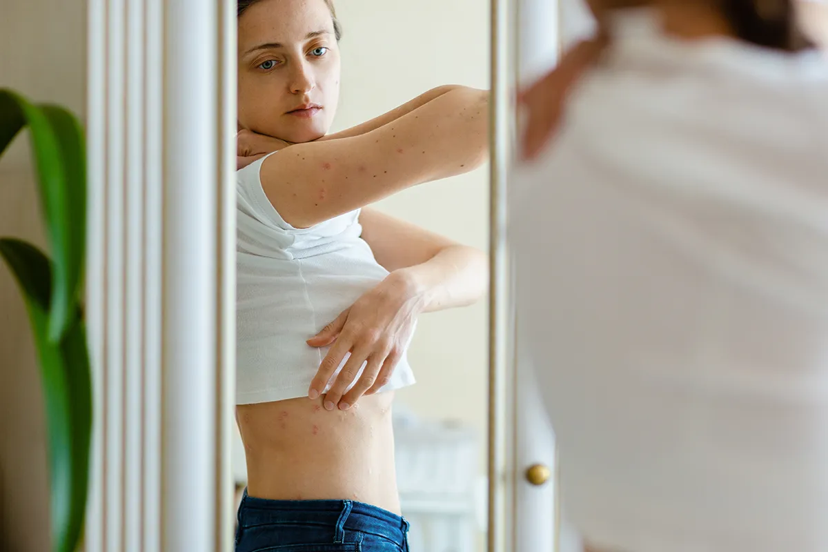 Eine weibliche Person vor einem Spiegel stehende mit vielen geröteten Hautstellen am Oberkörper