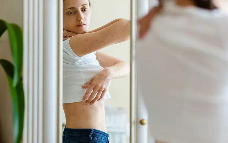 Eine weibliche Person vor einem Spiegel stehende mit vielen geröteten Hautstellen am Oberkörper