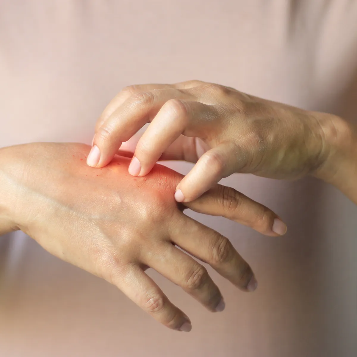 Eine Hand liegt auf einer anderen mit den Fingerspitzen auf und drunter sin rötliche Stellen zu sehen