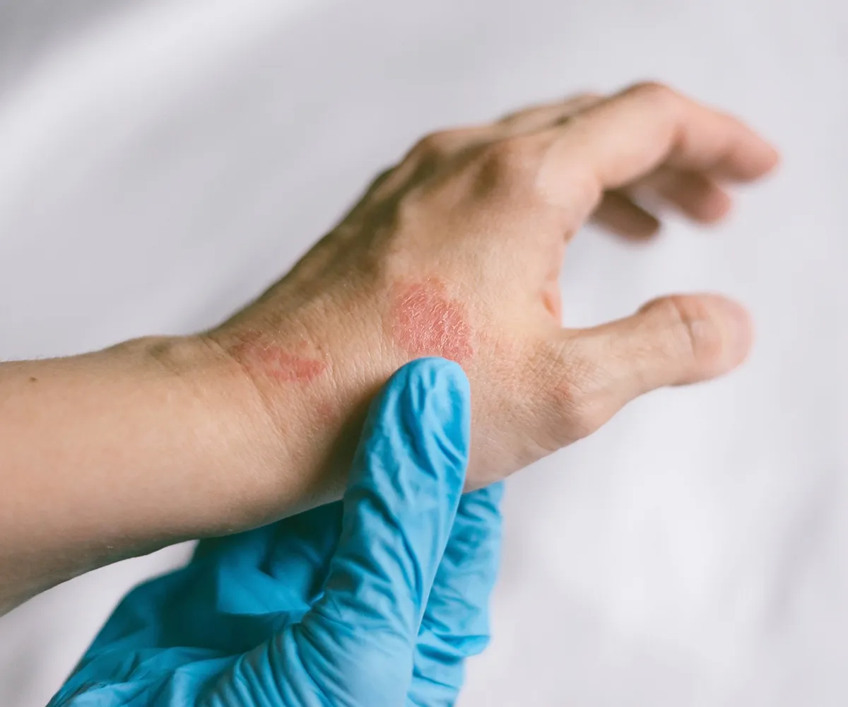 Eine Hand mit rissigen roten Stellen auf dem Handrücken wird von einer Hand im Latex Handschuh gehalten
