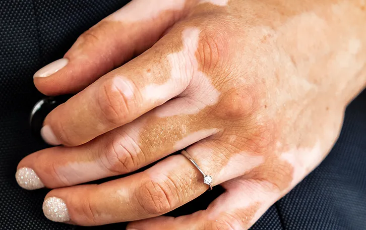 Eine Hand mit Pikmentstörungen