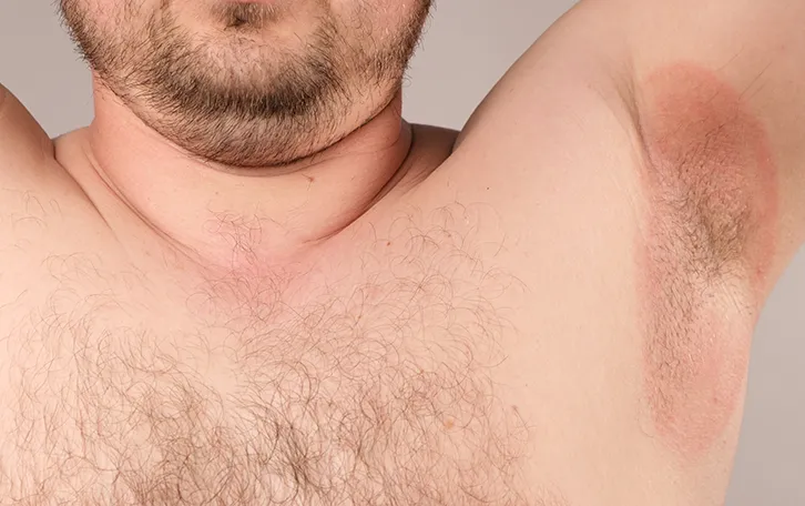 Männlich Person mit gerötetem Achselbereich